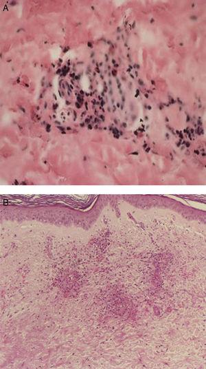 A y B). La biopsia de la piel afectada mostrada en la imagen anterior presenta en el panel superior, infiltrado en la dermis papilar, con extensión a la dermis reticular (40×) y un acercamiento, en el panel inferior, del infiltrado que ocupa toda la pared del vaso sanguíneo, con leucocitoclasia (100×, HE).