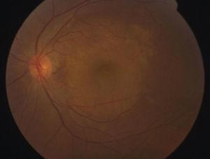 Escleritis posterior. Fotografía de fondo del ojo izquierdo, en la que se aprecia desprendimiento seroso macular (imagen redonda amarillenta) con acúmulo de líquido debido a inflamación esclerocoroidea posterior.