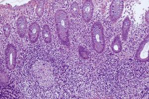 Biopsia de colon: infiltrado inflamatorio constituido por linfocitos, células plasmáticas, neutrófilos y eosinófilos con ocasionales granulomas (HE 10×).