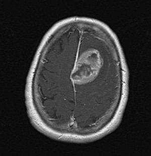 Axial cranial T1 magnetic resonance imaging after the administration of intravenous gadolinium that shows the presence of a left frontal mass of 3.5cm×4cm×3cm with heterogeneous peripheral enhancement.