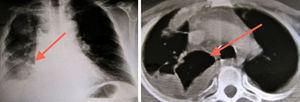 Radiografía de tórax (izquierda) y TC torácica (derecha) con infiltrado en la base pulmonar derecha y derrame pleural en el mismo lado.