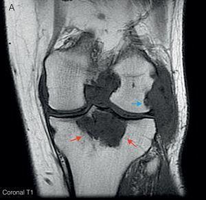 A) RM de rodilla izquierda corte coronal en T1. Muestra proliferación sinovial difusa hipointensa, con erosiones óseas en el margen posterolateral del cóndilo femoral (flecha azul) y en escotadura intercondílea. Lesión lítica hipointensa en epífisis proximal tibial con un diámetro máximo de 5cm (flechas rojas). B) Corte sagital en T2. Se observa un aumento heterogéneo de señal a nivel de la lesión lítica en epífisis tibial (flechas rojas); junto con un gran quiste de Baker situado por detrás del vientre muscular del gemelo interno (flechas verdes), con zonas de alta y baja señal, correspondientes a hipertrofia sinovial. C) Corte sagital en T1 con Gd. Tras la administración de gadolinio se objetiva realce periférico a nivel de la lesión lítica tibial (flechas rojas) y del quiste de Baker (flechas verdes).