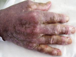 Imagen de las manos que muestra pápulas de Gottron en articulaciones metacarpofalángicas superpuestas a las lesiones hipopigmentadas de la poiquiloderma.