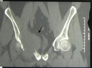TC pelvis: lisis en porción medial o superior del acetábulo, que se extiende al ala del ilion y a la rama superior del pubis, asociada a una gran masa de partes blandas de 12×74×73mm (flecha), que infiltra la musculatura.