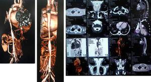 Angiotomografía computarizada. Estenosis a nivel de la subclavia izquierda, la aorta torácica, la aorta abdominal y las arterias renales.