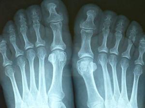Radiografía simple de pies. Aumento del espacio articular por hipertrofia del cartílago. Proliferación de los penachos.