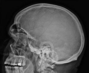 Radiografía simple de cráneo. Aumento de tamaño de la silla turca. Engrosamiento de la bóveda craneal. Tamaño aumentado de los senos paranasales.