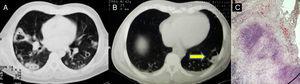 A) Múltiples nódulos bilaterales en la tomografía de tórax, algunos cavitados, con áreas de consolidación. B) Signo de la media luna aérea (flecha). C) Granuloma no caseoso en la biopsia pulmonar.