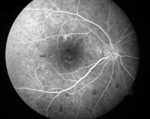 Angiografía del ojo derecho. Se aprecian microaneurismas en región temporal inferior y en una pequeña área temporal a mácula (flechas). Las imágenes hipo e hiperfluorescentes de fóvea (asterisco) no se modificaron a lo largo del angiograma.