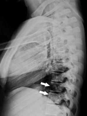 Radiografía lateral de columna dorsal mostrando el signo del «hueso dentro de hueso», más evidente en los cuerpos vertebrales inferiores (flechas blancas).