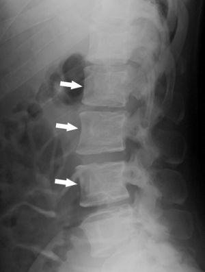 Radiografía lateral de columna lumbar mostrando hallazgos similares a los de la columna dorsal (flechas blancas).