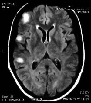 RM de cerebro que muestra lesiones hiperintensas en T2 en la región derecha frontal, temporal y parietal.