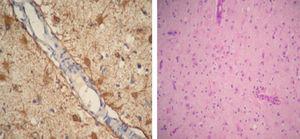 Difusa astrogliosis en la corteza cerebral y astrocitos reactivos, GFAP+ CD68+ (Luxol Fast Blue-hematoxilina-eosina).