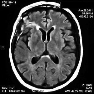 RM de cerebro luego del tratamiento con ciclofosfamida por vía intravenosa sin observarse lesiones.