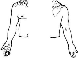 This sketch shows with dots pain radiation from the acromioclavicular and the sternoclavicular joints (C3 and C4-derived structures). The left half of the picture shows the front side and the right side of the picture, the back side.