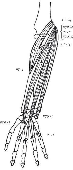 The flexor muscles of the wrist. FCR=flexor carpi radialis, PL=palmaris longus, and FCU=flexor carpi ulnaris. PT=pronator teres is not a wrist flexor but partially shares their origins.