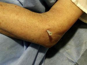 Infiltration of the elbow from its radial side. With the arm resting on a surface the needle is inserted vertically between the proximal end of radius and the lateral epicondyle.