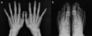 a y b) Radiografías de manos y pies mostrando osteopenia, ensanchamiento tubular epifisiario y pérdida del espacio articular, sin lesiones erosivas.