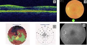 A) OCT: pérdida de la depresión foveal y separación de las capas externas de la retina. B) Fondo de ojo con cambios muy leves en la electrorretinografía. C) El campo visual presentaba escotoma central denso. D) Angiografía fluoresceína sin alteraciones.