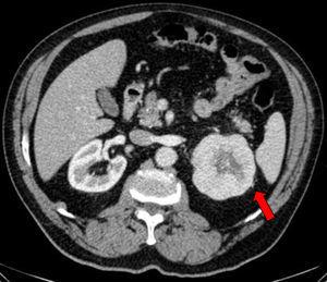 Tomografía computarizada donde se objetiva una masa de 79mm en el polo superior del riñón izquierdo, con centro necrótico y posibles focos de invasión grasa perirrenal en su margen superior.