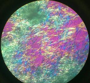 Cristales de urato monosódico vistos al microscopio de luz polarizada.