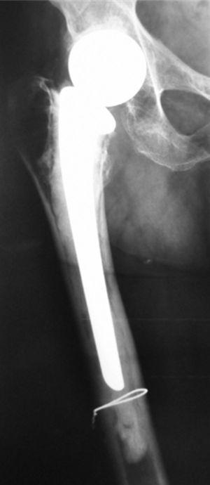 Radiografía de prótesis de cadera.