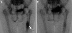 a) Gammagrafía ósea que muestra la movilización de la prótesis a nivel de la diáfisis femoral (flecha). b) Mismo paciente tras 6 meses de tratamiento con ranelato de estroncio.