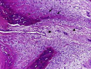 Microfotografía de la lesión en la que se observa producción de osteoide inmaduro (asterisco), con abundantes osteoblastos (flechas) que se originan de un estroma fibroso (cabezas de flecha) (hematoxilina-eosina, 10×).