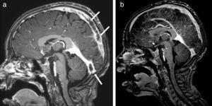 (a) Magnetic resonance imaging of brain before the infliximab. Hyperintense thrombosis filling the superior sagittal sinus and proximal segments of both transverse sinuses was showed and (b) after second dose of infliximab, significant dissolution of the thrombosis was observed in the brain MRI.