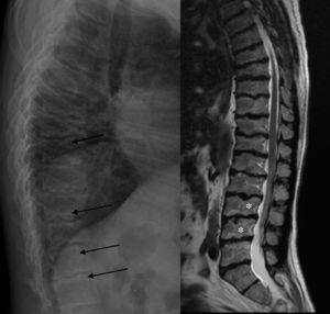 Radiografía y RM-T2 dorsolumbar: irregularidad de los platillos vertebrales (flechas). Se visualizan algunas hernias intraesponjosas lumbares en la RM (*).