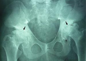 Radiografía pelvis: displasia caderas con pinzamiento de los espacios coxofemorales, acetábulos aplanados (flechas), deformidad cabezas femorales (^^) y osteofitos secundarios (*). Esclerosis de la sínfisis púbica (flecha fina).