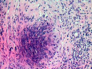 Detalle de granulomatosa epitelioide necrosante rodeado por células en empalizada.