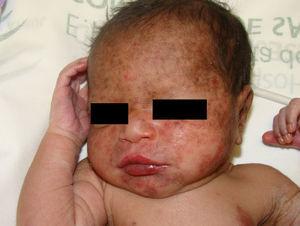 Caso clínico 2. Lesiones eritemato-marronáceas descamativas en la cara, con distribución periocular en antifaz.