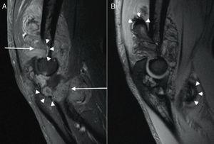 (A) Sagital T1 Fat-saturated image of the left elbow after intravenous gadolinium administration, showing an enhancing soft-tissue mass (arrows) associated to bone erosions (arrowheads). (B) Sagital T2* weighted image, showing areas of marked low signal intensity (arrowheads) suggestive of hemosiderin deposits.