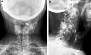 Radiografía de columna cervical anteroposterior y perfil.