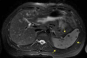 RMN abdominal con gadolinio T2 con lesiones esplénicas (flechas).