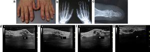 Atrosis IFD: imagen de las manos (A), radiografía (B), zoom de la articulación (C) y estudio ecográfico correspondiente desde dorsal (D), medial (E), lateral (C) y palmar (D).