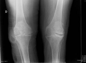 Radiografía de rodillas en carga. Se aprecia la presencia de una lesión de contenido hidroaéreo lateral en la rodilla derecha con aumento de partes blandas. Se aprecia también una segunda lesión del mismo aspecto distal a la lesión previamente conocida.