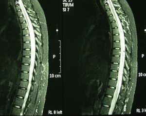 Resonancia magnética en secuencia T2, con mielitis de gran segmento en la médula espinal dorsal, desde D5 hasta D12. Ensanchamiento medular con señal hiperintensa, concordante con su enfermedad de base.