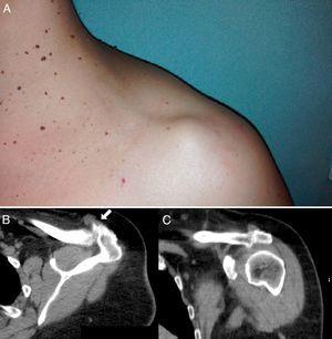 A) Aspecto externo de la tumoración. B) TC de hombro, corte a través de la articulación acromioclavicular, en la que se aprecia la comunicación entre la articulación y la tumoración (flecha). C) Corte coronal a través de la articulación acromioclavicular con distensión capsular.