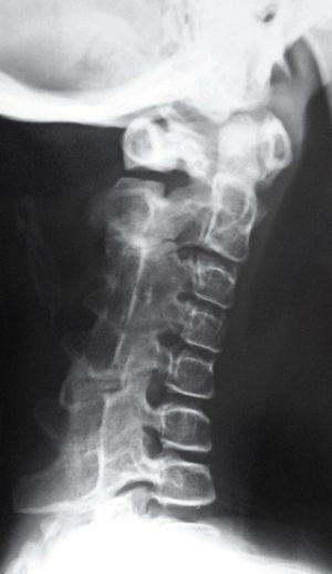 Hipoplasia de los cuerpos vertebrales, con hipertrofia y fusión de elementos vertebrales posteriores, que ocasiona bloque cervical C3-C5 y, como consecuencia, rectificación de la curvatura fisiológica.