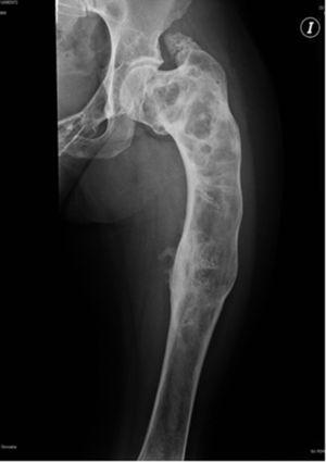 Radiografía anteroposterior de fémur izquierdo con una deformidad en «cayado de pastor», una cortical adelgazada e imágenes radiolucentes expansivas.