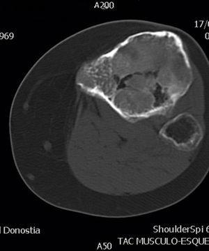 Tomografía computarizada de la tibia con cortes axiales a nivel de extremo proximal.