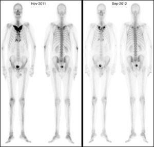 Gammagrafía ósea con Tc99 donde se muestra la evolución favorable después del tratamiento. Fuente: con autorización de Rosero A et al.13.