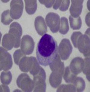 Frotis de sangre periférica: linfocitos grandes granulares.