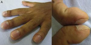Digital clubbing. (A) Clubbed appearance of distal phalanges. (B) Positive Schamroth's sign: the normal diamond-shaped window created by placing the dorsal surfaces of terminal phalanges on opposing fingers together is obliterated in clubbing.