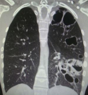 Chest computer tomography scan showing cystic bronchiectasis and cavitation in the left lower and upper lobes.