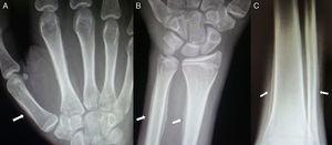 Radiographs of wrists (A and B) and legs (C) showing periostosis (arrows) at metacarpals, distal ends of the radius, ulna, tibia and fibula.