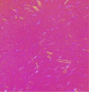 Cristales de urato monosódico en microscopia con luz polarizante.
