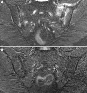 Caso 3. A) RM con afectación bilateral asimétrica con edema óseo en ambas articulaciones y capsulitis en la sacroiliaca izquierda, demostrativo de sacroilitis activa. B) Resolución completa del edema óseo y de la capsulitis a los 17 meses de dieta sin gluten.